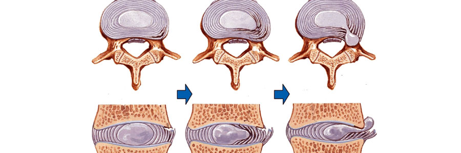 Populāri par starpskriemeļu trūcēm.